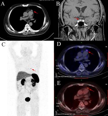 Case Report: An Unusual Case of Ectopic ACTH Syndrome Caused by Mediastinal Paraganglioma